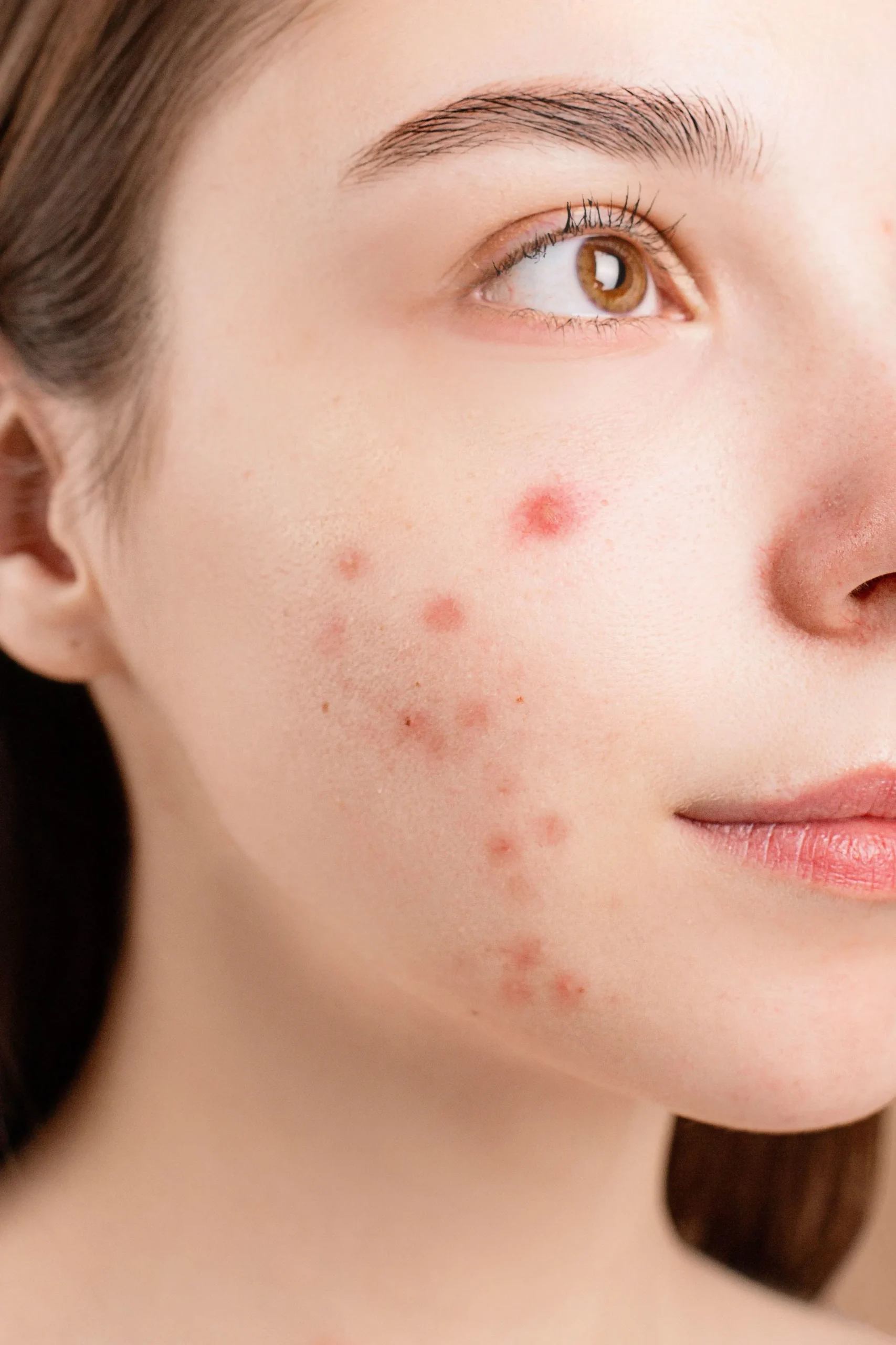 What Is Deep-Cyst Acne?