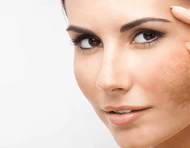 How to Get Rid of Melasma
